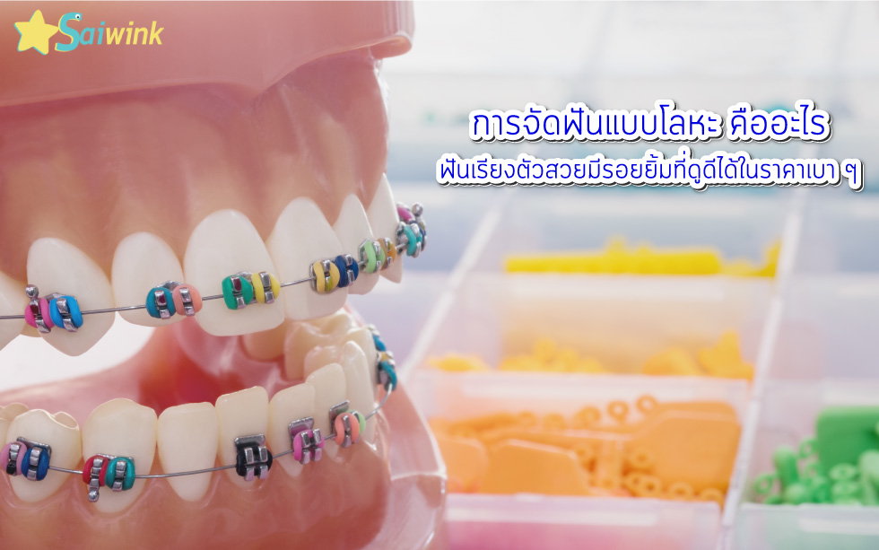 การจัดฟันแบบโลหะ-คืออะไร