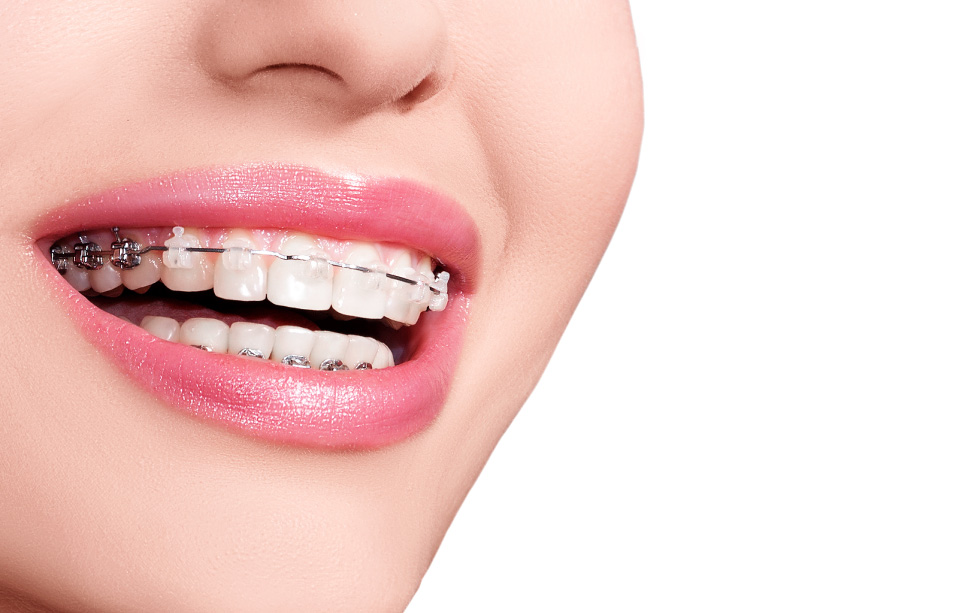 การจัดฟันแบบดามอน