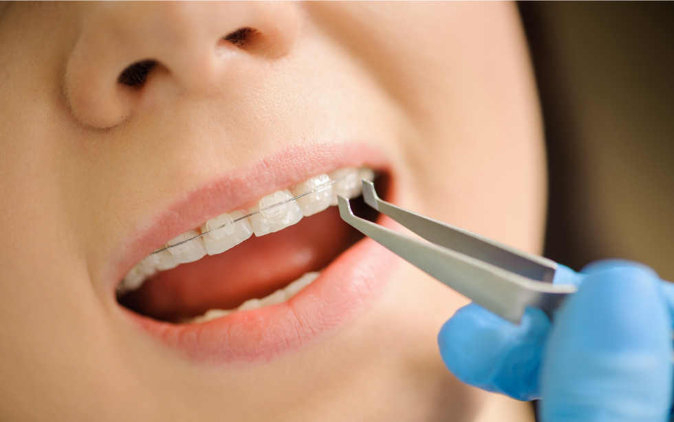 การจัดฟันแบบเซรามิก