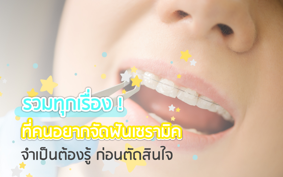 รวมทุกเรื่องที่คนสนใจ-การจัดฟันแบบเซรามิก-จำเป็นต้องรู้