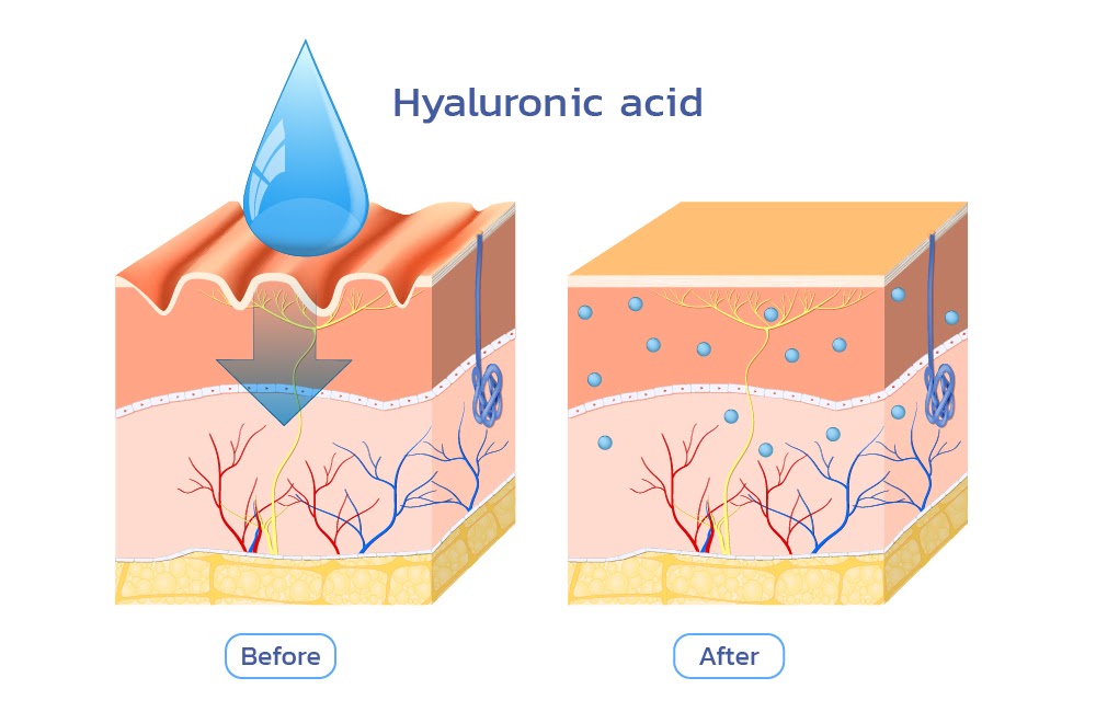 Vene varice cu acid hialuronic - Acid hialuronic și varicoză