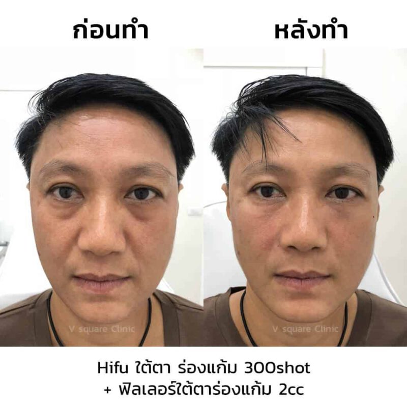 Hifu ลดถุงใต้ตา และร่องแก้ม Hifu ลดถุงใต้ตา และร่องแก้ม