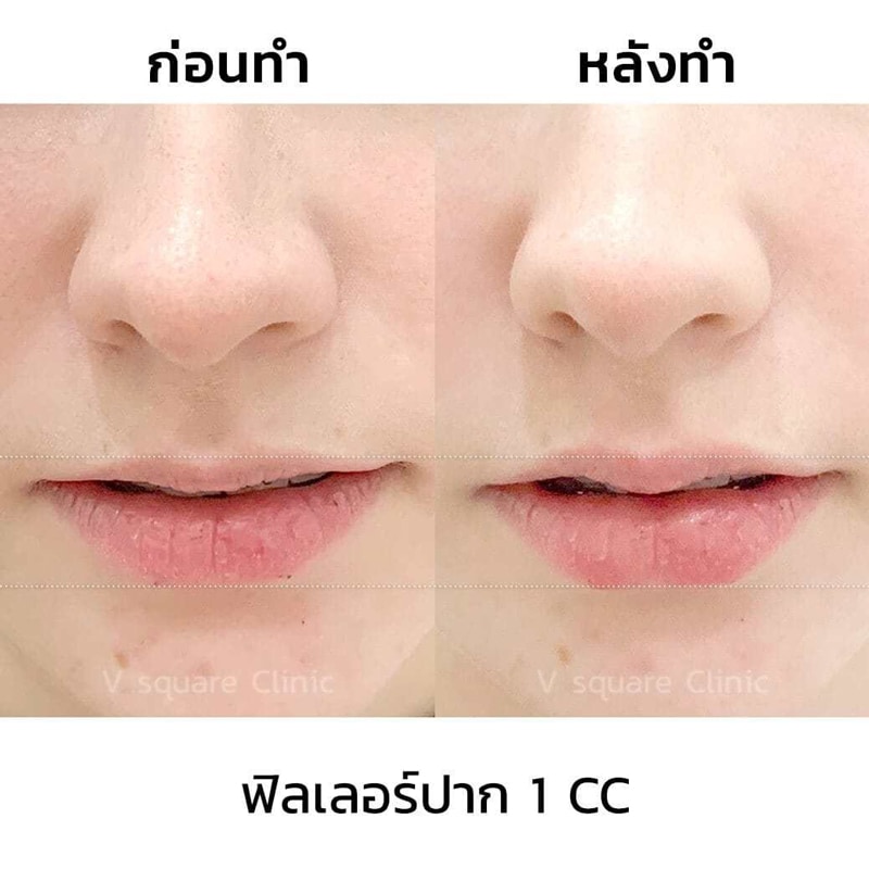 ฉีดฟิลเลอร์ปาก รีวิว ฉีดฟิลเลอร์ปาก รีวิว