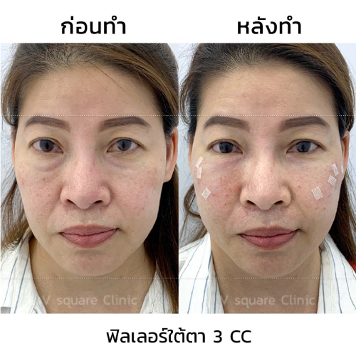 ฉีดฟิลเลอร์ใต้ตา-ลดถุงใต้ตา ฉีดฟิลเลอร์ใต้ตา-ลดถุงใต้ตา