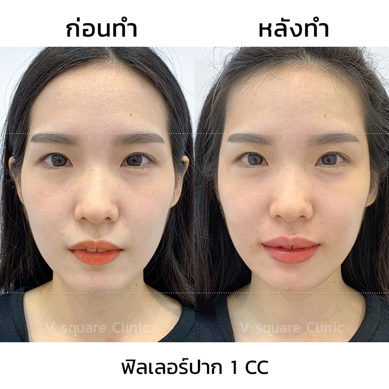 ตัวอย่างรีวิว ผลการฉีดฟิลเลอร์ปาก 1 cc ตัวอย่างรีวิว ผลการฉีดฟิลเลอร์ปาก 1 cc