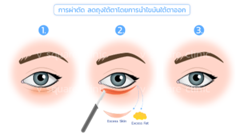 ผ่าตัด ลดถุงใต้ตา ผ่าตัด ลดถุงใต้ตา