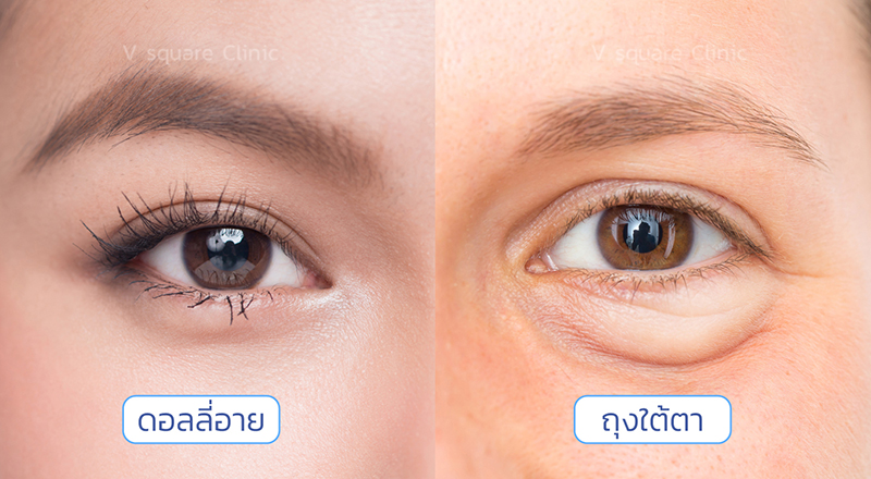 เปรียบเทียบดอลลี่อาย VS ถุงใต้ตา เปรียบเทียบดอลลี่อาย VS ถุงใต้ตา