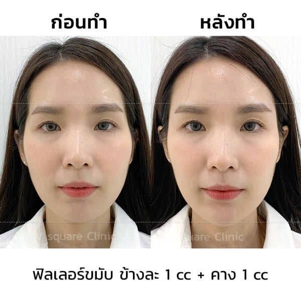 ฉีดฟิลเลอร์คางและขมับ