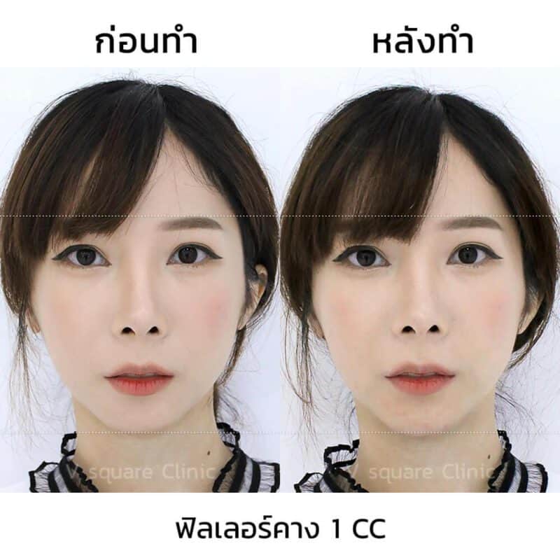 แก้คางสั้นด้วยการฉีดฟิลเลอร์คาง