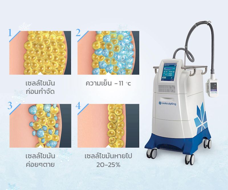 ลดพุงด้วยเครื่อง CoolSculpting