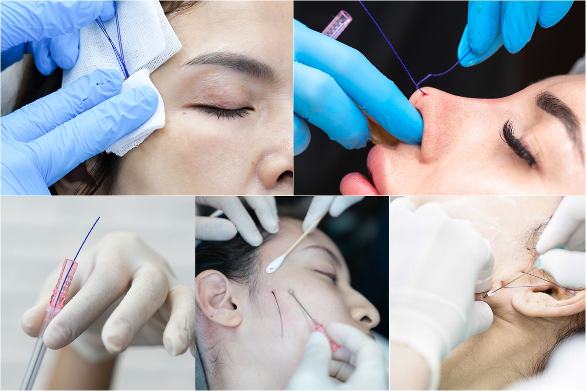 ร้อยไหม