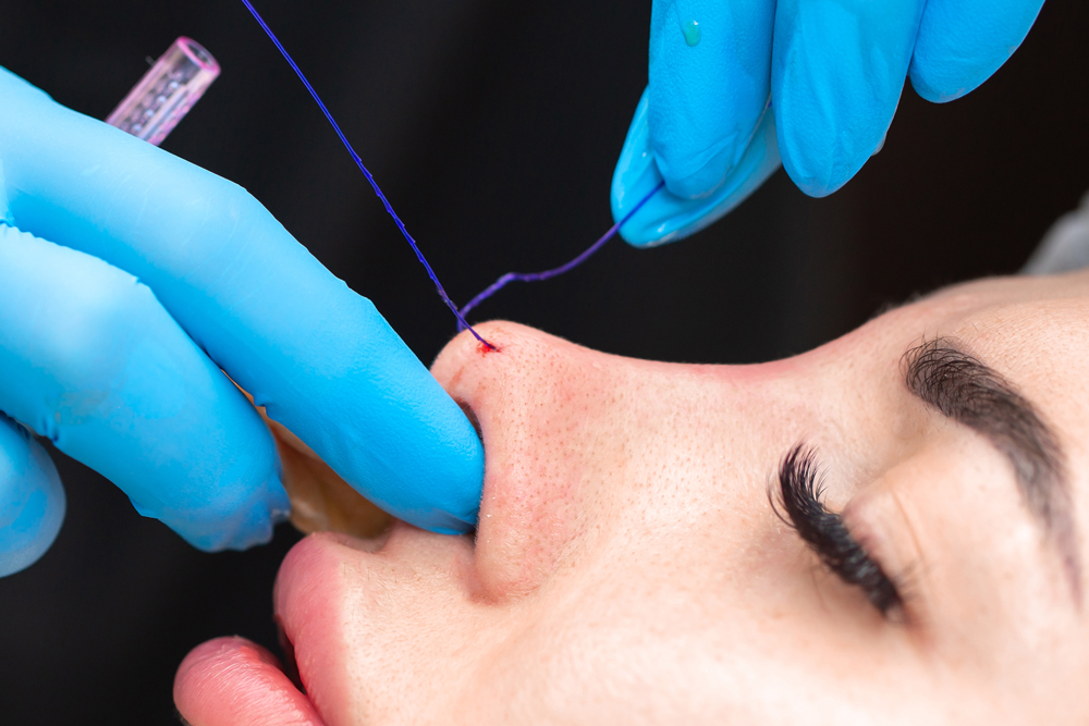 ร้อยไหมจมูก