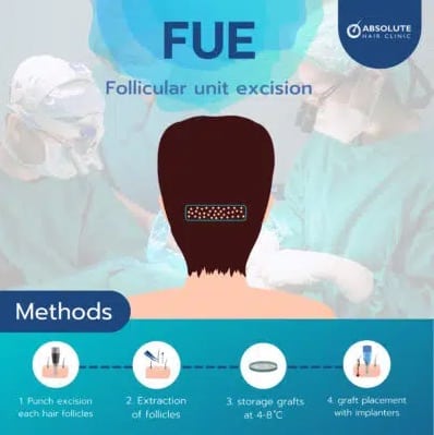 ขั้นตอนปลูกผม FUE