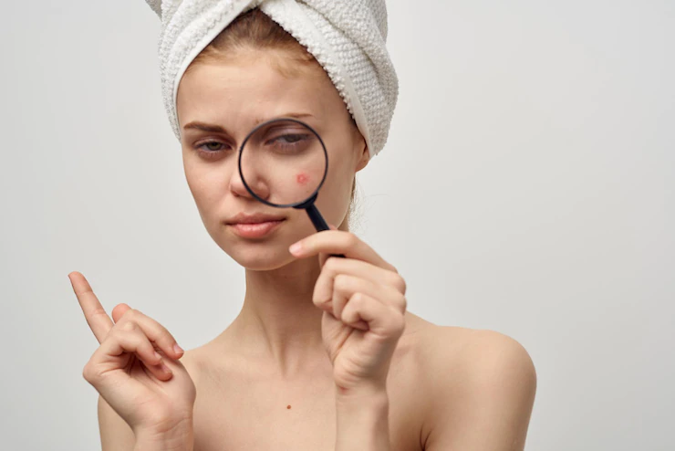 สิวหัวหนอง