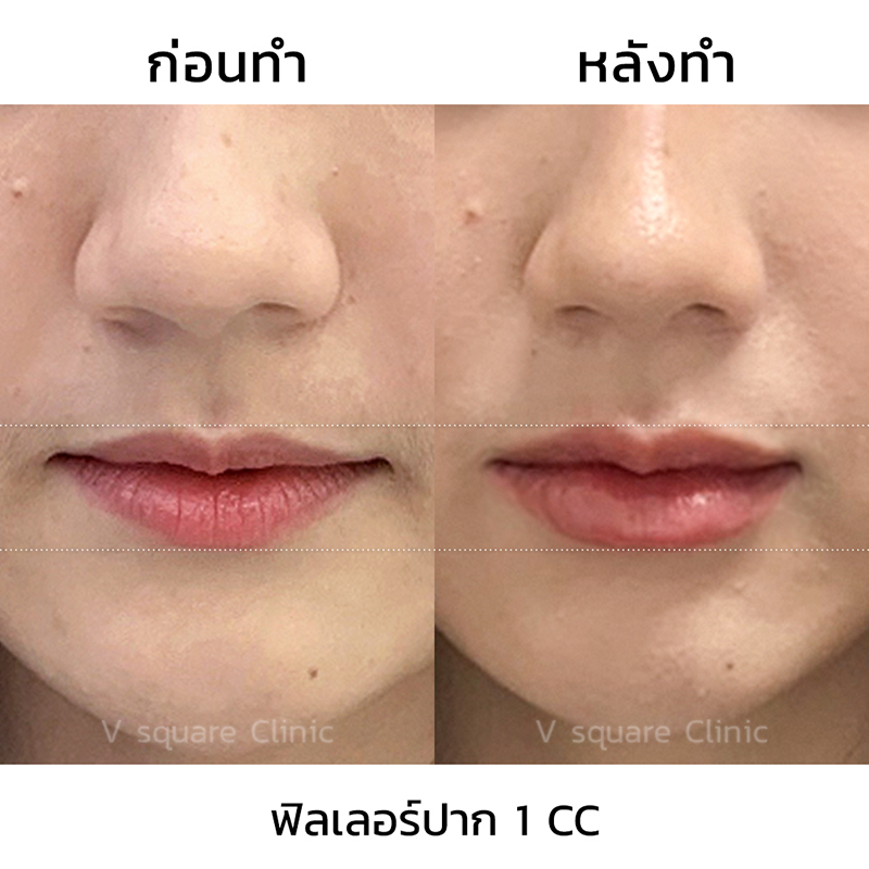 ฉีดปากเกาหลี
