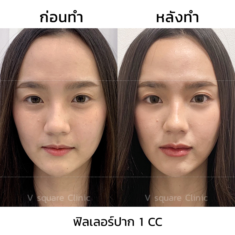 ฉีดปากเกาหลี