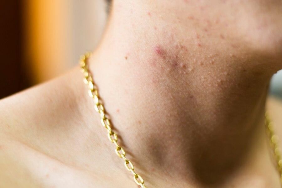 สิวที่คอ