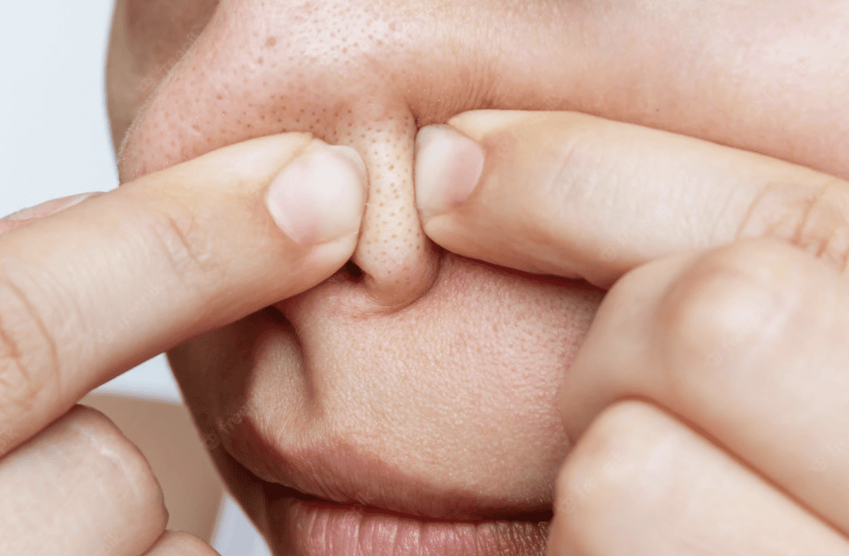 สิวอุดตัน