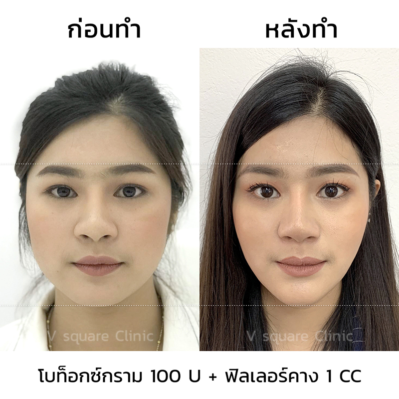 รีวิว ก่อนทำ และหลังทำการฉีดโบท็อกปีกจมูก