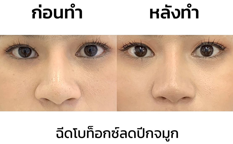 รีวิว-โบท็อกปีกจมูก