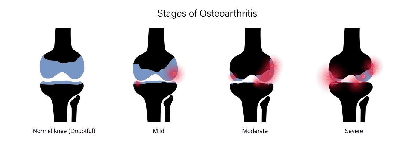 ข้อเข่าเสื่อม อาการ