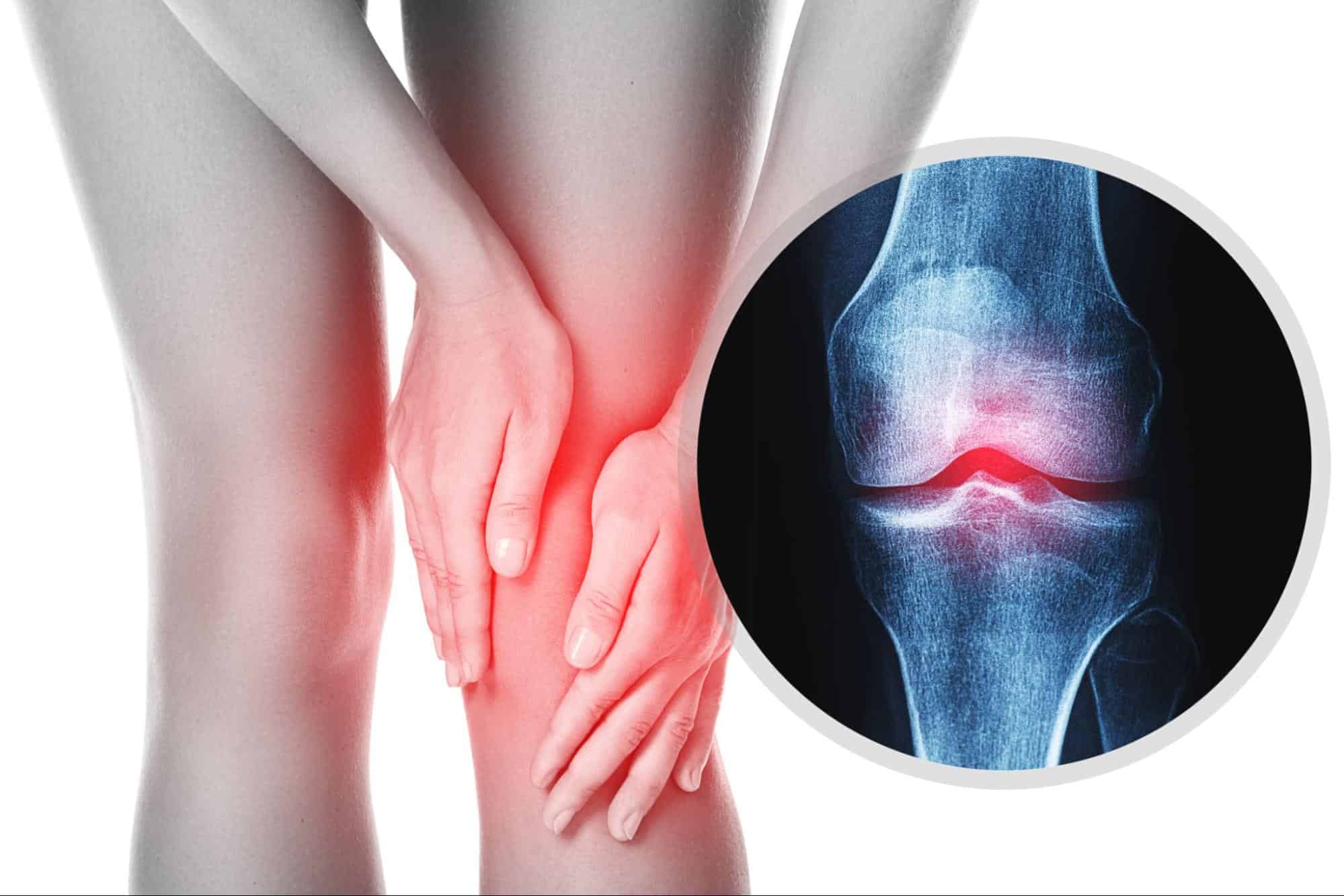 ข้อเข่าเสื่อม เกิดจาก